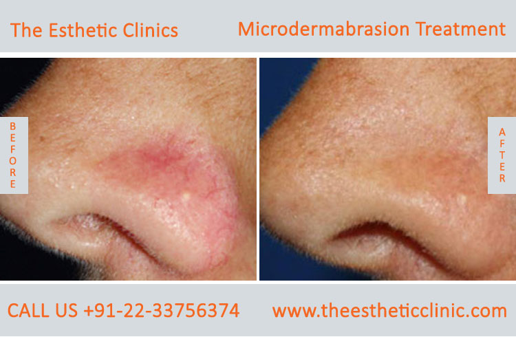 Microdermabrasion Dermabrasion Treatment before after photos in mumbai india (3)